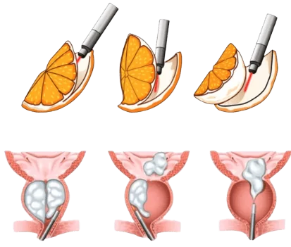 Ilustração da enucleação da próstata a laser