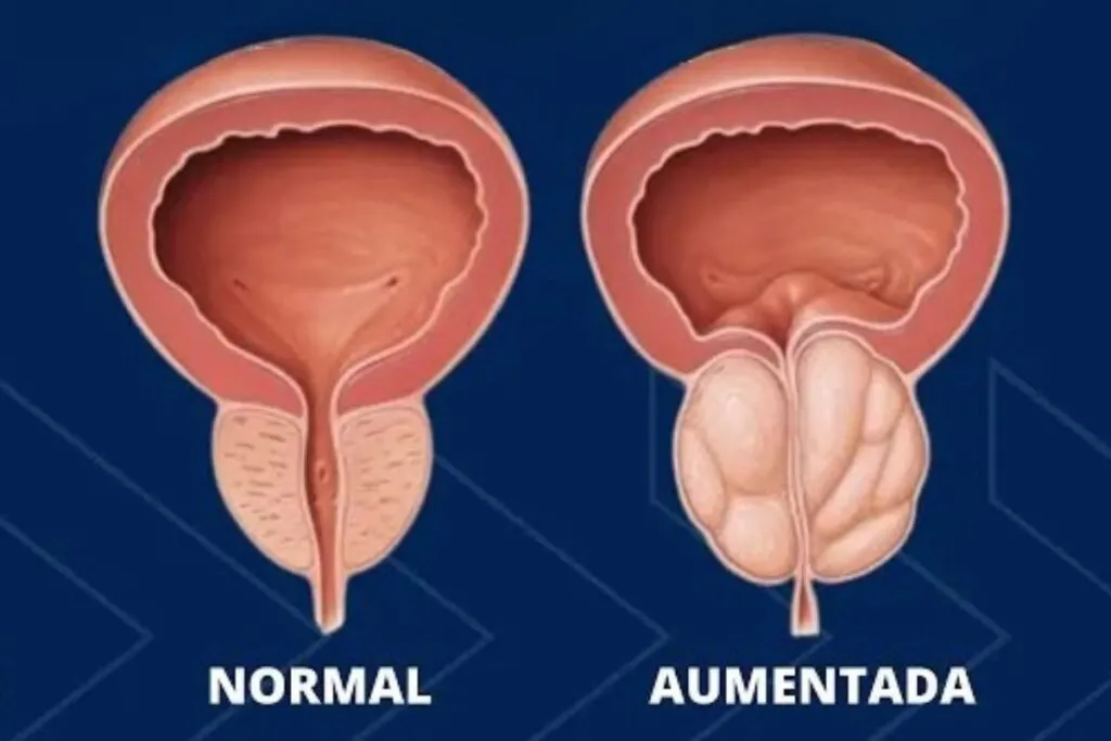 Comparação entre próstata de tamanho normal e próstata aumentada